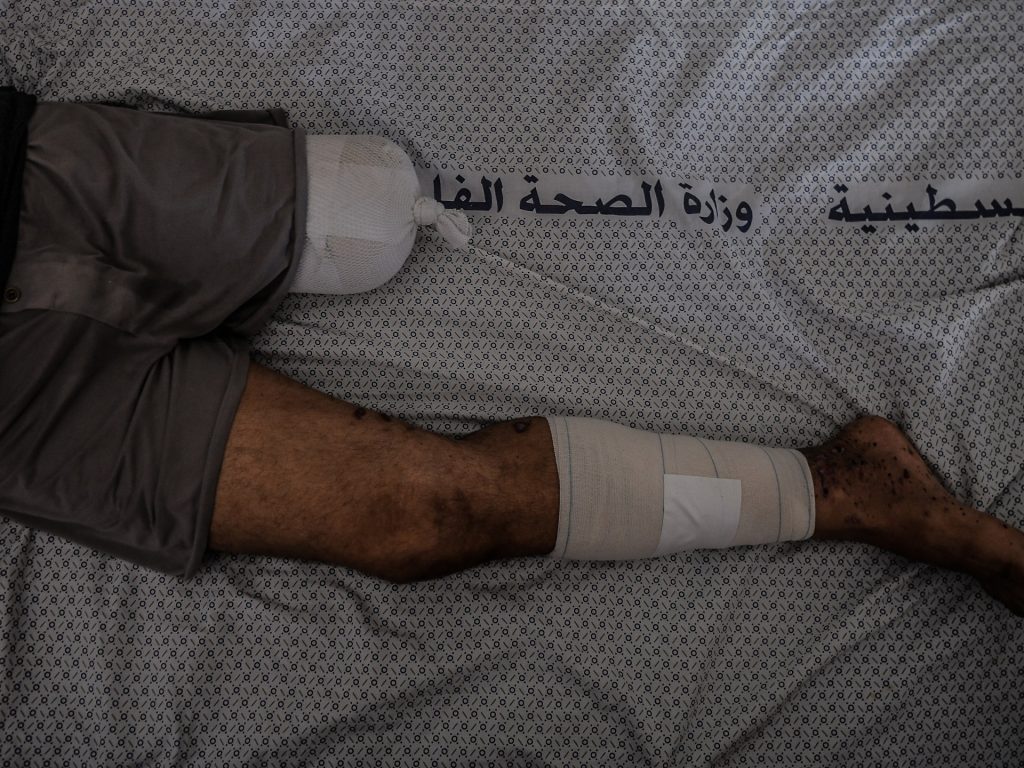 In Gaza, la morte sembra più facile dell'amputazione