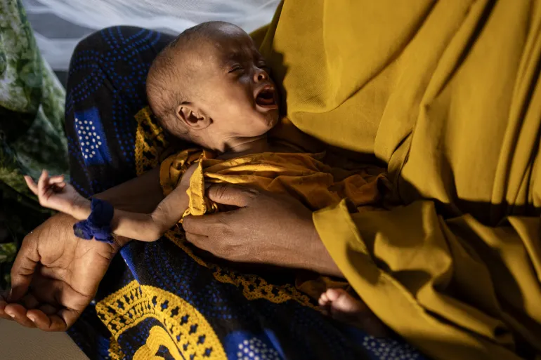 Una donna somala recentemente sfollata tiene in braccio il suo bambino gravemente malnutrito in un centro di stabilizzazione per bambini che soffrono di malnutrizione acuta grave a Kismayo,